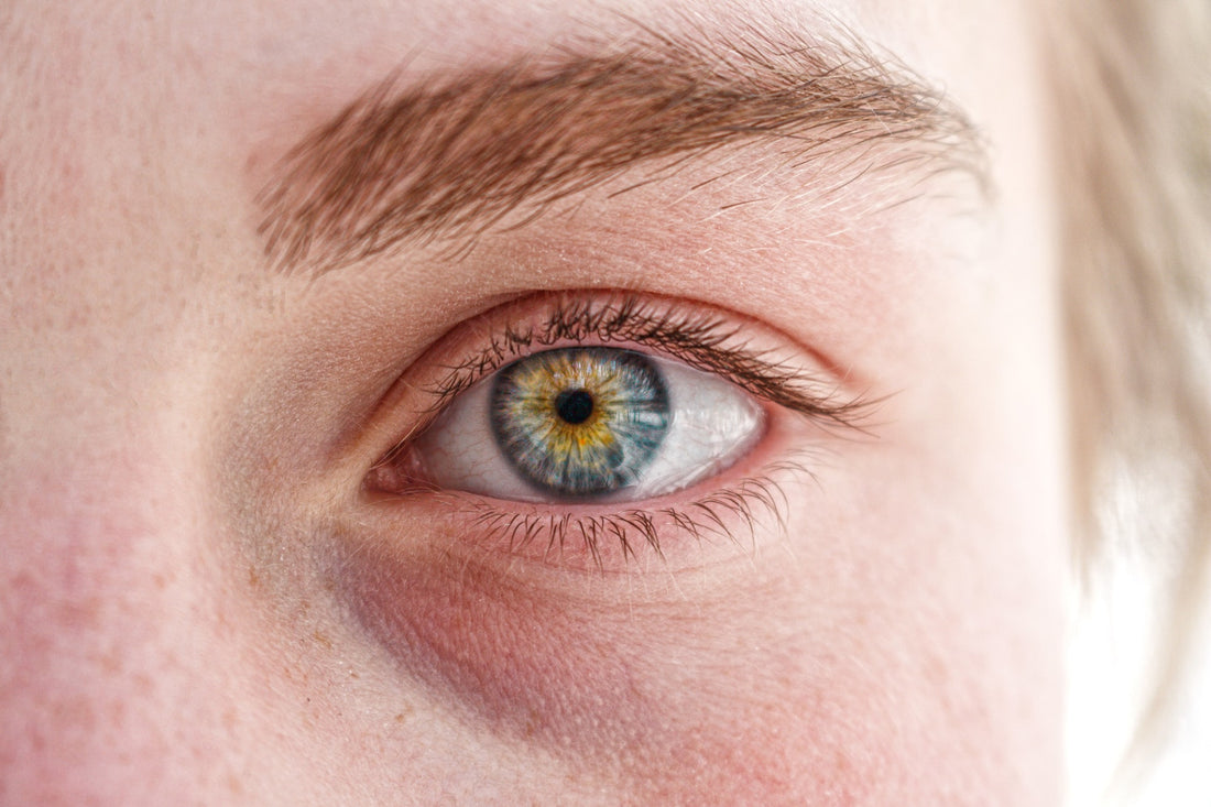 Ask a Dermatologist: What Causes Dark Circles Under Eyes?